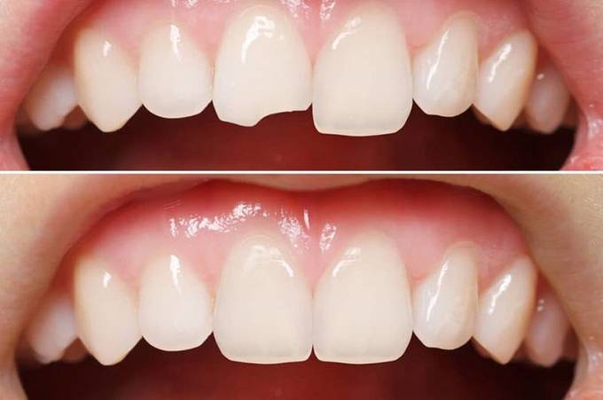 Реставрация зубов: что нужно знать 